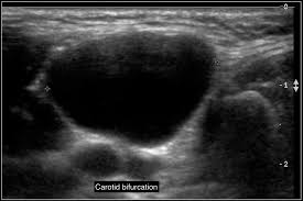 Ultrasoundis very sensitive and showsmany nodules that cannot be felt. The Radiology Assistant Neck Masses In Children