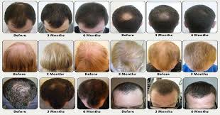 Regrowing Your Hair Made Easy With These Natural Oils Hair Loss Remedies Help Hair Loss Natural Hair Loss