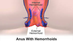 Hemorrhoids (piles) are commonly caused by straining while having a bowel movement, pregnancy, colon cancer, constipation, or chronic diarrhea. Types Of Hemorrhoids Symptoms Treatment And More