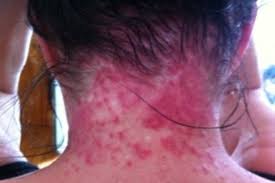 Chemical scalp burns are usually caused by hair products such as dyes, bleaches or relaxers. Hair Dye Burns Wainuiomata Woman Like Someone S Poured Acid All Over My Head Stuff Co Nz