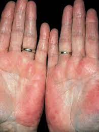 lupus.org … patchy eruption that heals with scarring and atrophy of the skin and may be found anywhere on the body, (3) raynaud syndrome ( see below ), (4) photosensitivity. Sign Mention Causes Faculty Of Medicine
