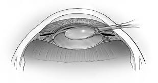 Image result for Cataract Extraction