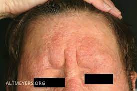 Dear suffering12, skin disorders that affect permanent loss of hair can be quite numerous. Keratosis Pilaris Syndrome Overview Altmeyers Encyclopedia Department Dermatology