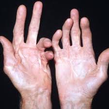 Check spelling or type a new query. Aortica Contractura De Dupuytren Es Una Afeccion De Facebook