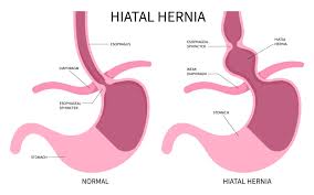 Image result for stomach hernia symptoms