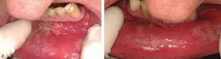 Image result for syphilis ulcer