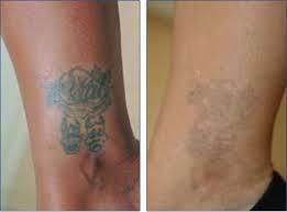 Dovme Nasil Silinir Con Imagenes Tatuajes Caseros Consejos Para La Salud Remedios