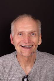 Upper and Lower 'All-On-X'