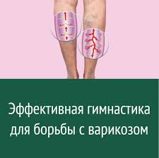 как избавиться от целлюлита при варикозе в домашних условиях Sovety V 2020 G Varikoz Fitnes Uprazhneniya Zdorove