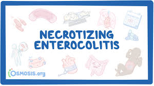 Image result for Necrotizing Enterocolitis