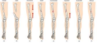 Image result for Fracture Types
