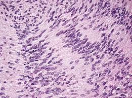 Schwannomas, less commonly called neurinomas or neurilemmomas, are benign tumors of schwann cell origin and are the most common tumor of peripheral nerves, including cranial nerves. 4 Histopathology Of Vestibular Schwannoma Neupsy Key