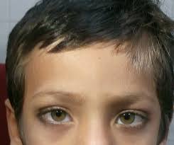 Over time, less melanin is available during hair growth, and this loss of pigment causes the hair to turn gray, silver and eventually white. White Lock Of Hair With Heterochromia Spot Diagnosis Pediatric Oncall