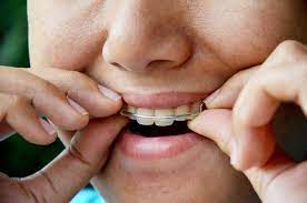 Review 10 best clear retainers providers. How Long Do You Have To Wear Retainer After Braces Your Dental Health Resource