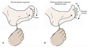 Image result for Babinski Reflex