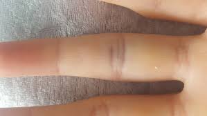 Kapselriss an finger, schulter, knie und co.: Habe Ich Einen Kapselriss Gesundheit Und Medizin