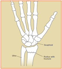 Check spelling or type a new query. Wrist Fracture Treatment In Raleigh John Erickson Md