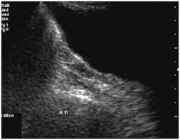 JCDR - Karyotype, Pure gonadal dysgenesis, Sensorineural deafness