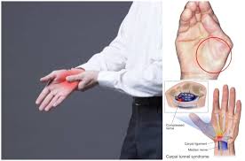 Rasa Sakit Di Tapak Tangan Mungkinkah Anda Penghidap Sindrom Carpal Tunnel
