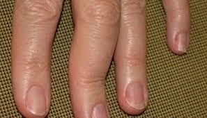 There is a reason these issues occur. Psoriatic Arthritis In The Hands Symptoms Pictures And Treatment