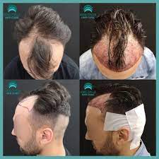 Il trapianto di capelli senza rasatura è il metodo considerato un sogno per i pazienti che non vogliono radersi i capelli. Gmg Clinic Italia E Possibile Effettuare Il Trapianto Senza Rasatura Completa Per Saperne Di Piu Contattaci Al Numero 39 347 570 2510 E Prenota La Tua Visita Gratuita