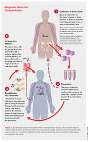 Your medical team collects stem cells from your own marrow or blood and stores them while you get cancer treatment. Allogeneic Stem Cell Transplantation Leukemia And Lymphoma Society