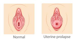 Can You Have Intercourse With Prolapsed Uterus?