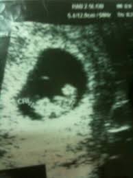 نوع البيبي من كيس الجنين والله اعلم تم نقاشه سابقا انظري قوانين القسم عالم حواء