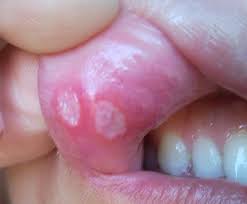 We did not find results for: Petua Dan Cara Hilangkan Ulser Mulut Eratuku