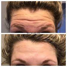 You can always start out light and add more. Botox Before And After My Botox Experience