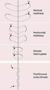 The vertical mattress stitch, often called vertical donati stitch (named after the italian surgeon mario donati), is a suture type used to close skin wounds. Subcuticular Suture Medical Dictionary Surgical Tech Suture Techniques