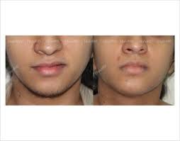 When you look at a man's or a woman's face, there is one physical feature you notice almost straight away: 20 Best Laser Hair Removal Results Before And After Hairmd Pune Ideas Laser Hair Removal Results Laser Hair Removal Treatment Laser Hair Removal