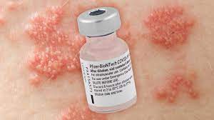 Both of these conditions are caused by the varicella zoster virus (vzv). New Side Effect From Mrna Covid Vaccines Medpage Today