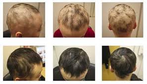 If you notice your child's hair thinning, it could be a sign of thyroid gland problems. Children S Hair Loss 10 Causes You Might Not Be Aware Of