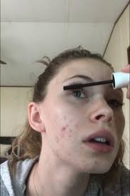 Does acne treatment burn sensitive skin easily?