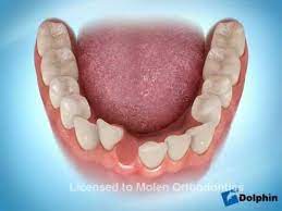 Single Lower Incisor Extraction Youtube Third Molar Braces Before And After Dentistry