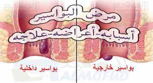مرض البواسير أسبابه و أعراضه و طرق علاجه