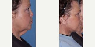 T. Gerald O`Daniel, MD, Board Certified Plastic Surgeon