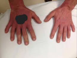 Image result for Polydactyly