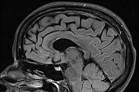 Image result for Brain Lesion