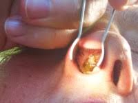 They line the inside of your nose or your sinuses. Rhino Sinusitis Ent Kent