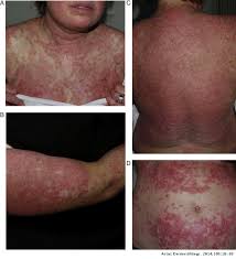 Borrowed from latin lupus (wolf). Drug Induced Lupus Erythematosus Actas Dermo Sifiliograficas