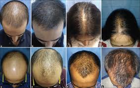 The process is meticulous — with injections beginning across the scalp,. Platelet Rich Plasma Therapy For Androgenetic Alopecia Sharma Vk Bhari N Patra S Parihar As Indian J Dermatol