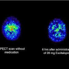 The dosage is based on your medical condition, response to treatment, age, and other medications if you are using the liquid form of this medication, carefully measure the dose using a special measuring. Effect Of A Single Dose Of Escitalopram 20 Mg On An 123i Adam Spect Download Scientific Diagram