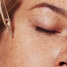 A guide to hyperpigmentation treatment and prevention