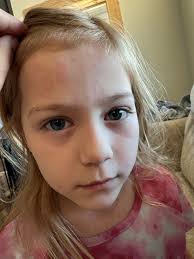 Rashes around old stoma site after reversal surgery