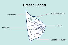 Image result for Breast Cancer