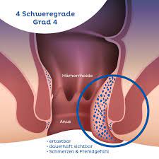 Während jeder hämorrhoiden bekommen kann. Hamorrhoiden Haufige Symptome Stadien Netdoktor At