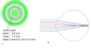 We did not find results for: Myopia Control With Soft Contact Lenses
