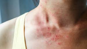 Your Liver Won T Tell You That It S Fatty But These Signs May In 2020 Skin Diseases Dermatitis Herpetiformis Itchy Skin